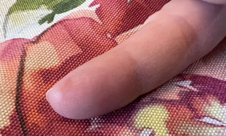 Burnt finger two days after healing